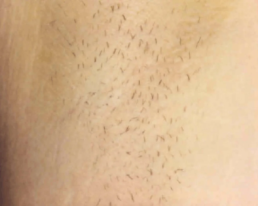 Close up before laser hair removal