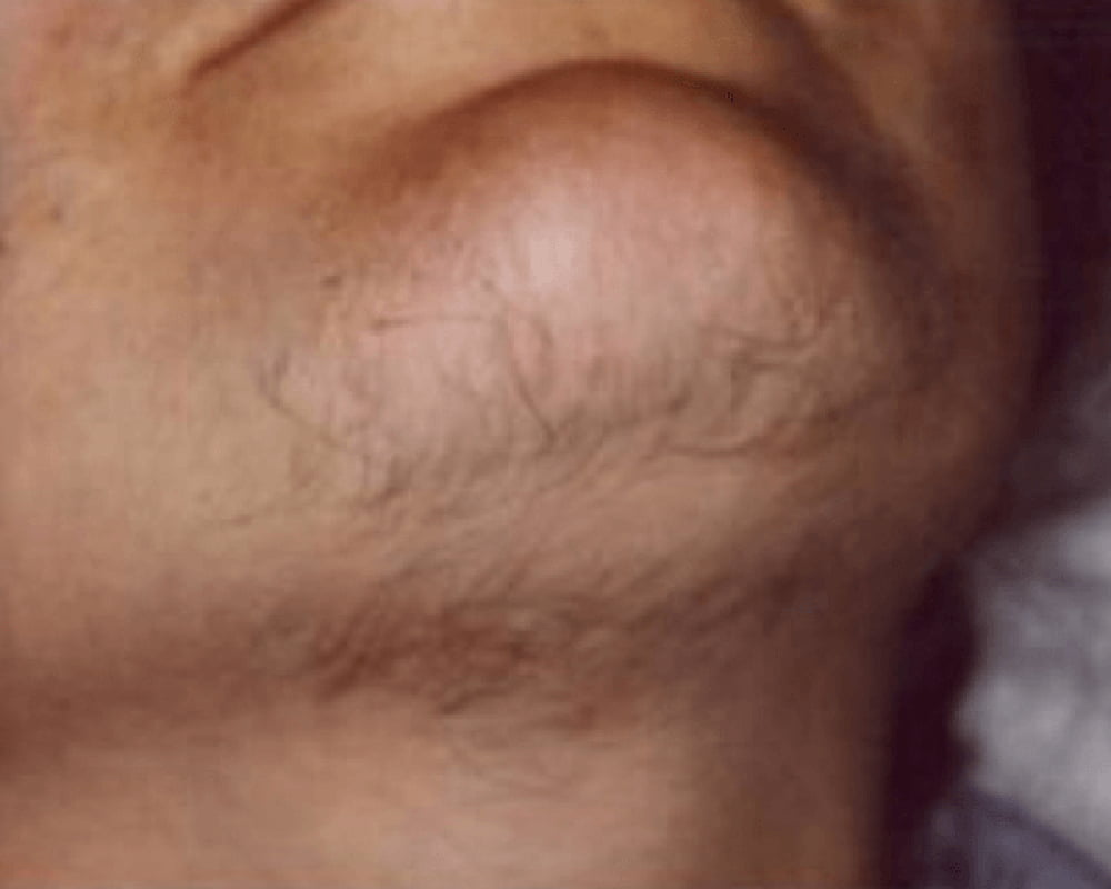 before chin laser hair removal