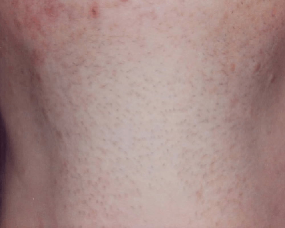 man's chest after laser hair removal