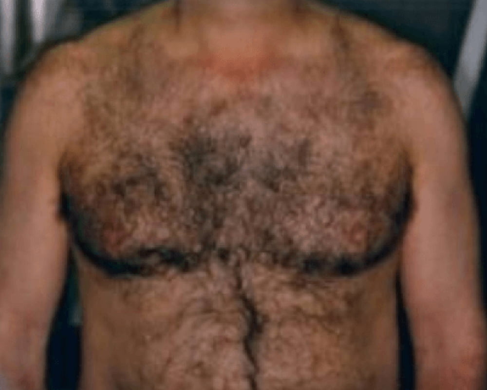 man's chest before laser hair removal