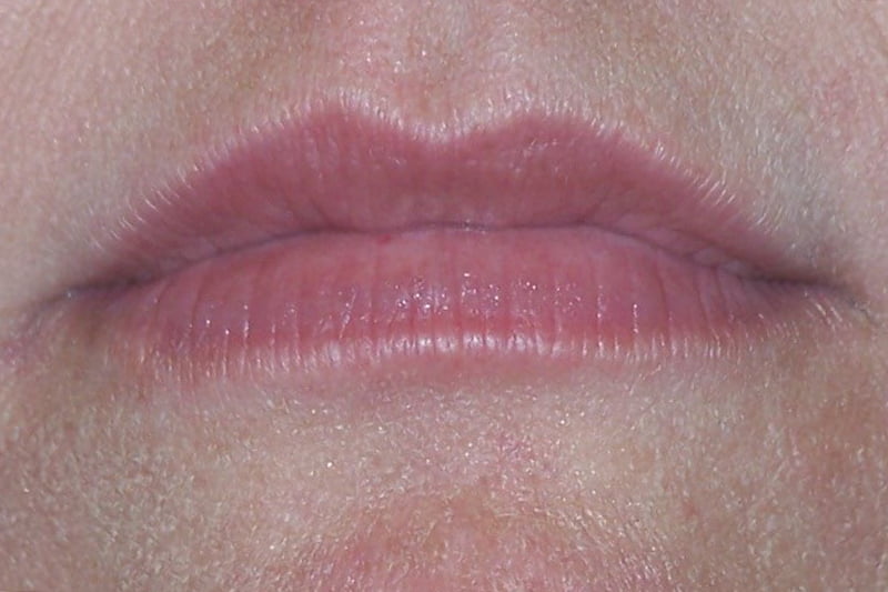 close up of lips before filler