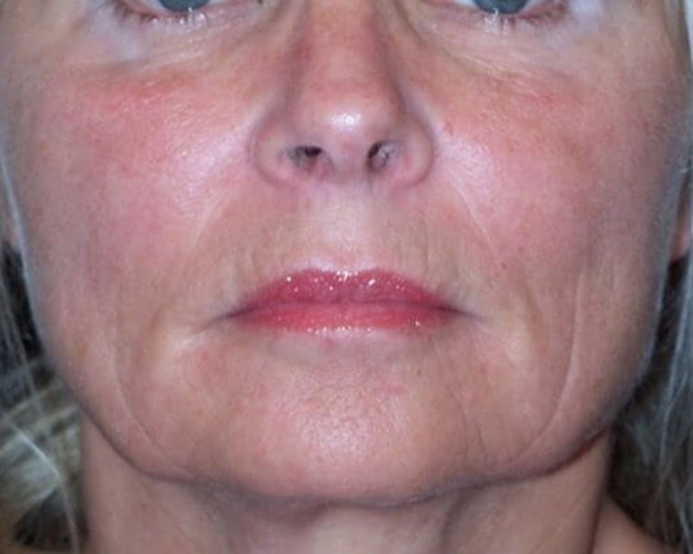 woman's face after treatment