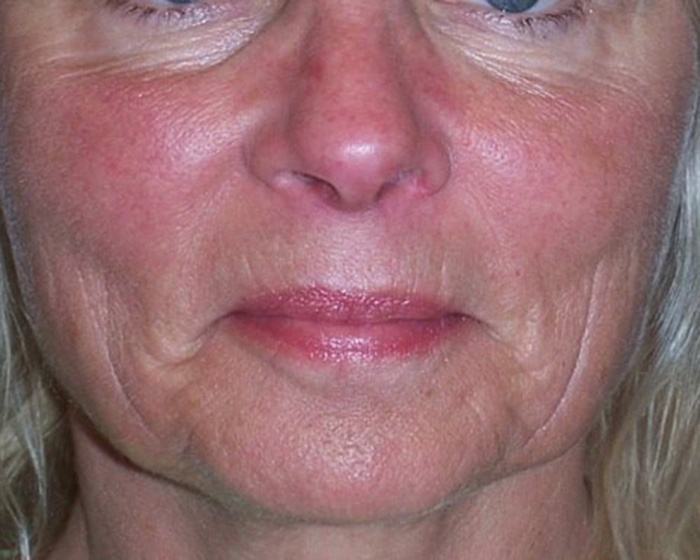 woman's face before treatment