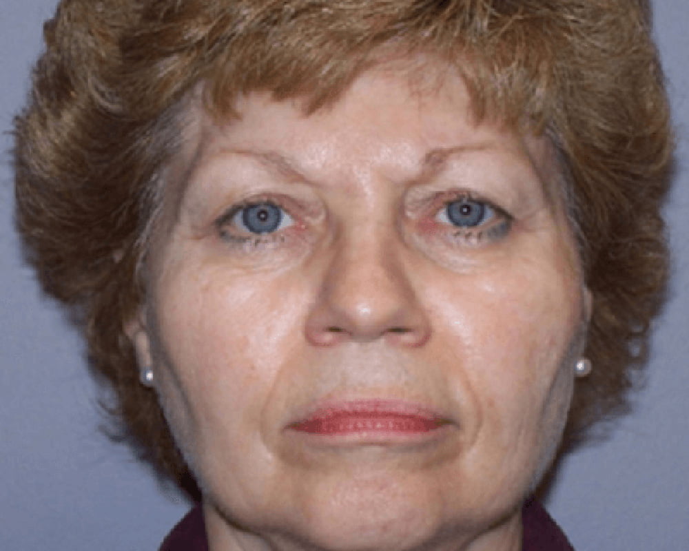 woman before treatment