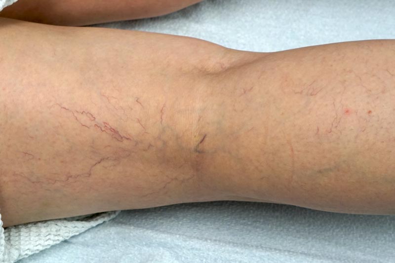 woman's leg before sclero treatment