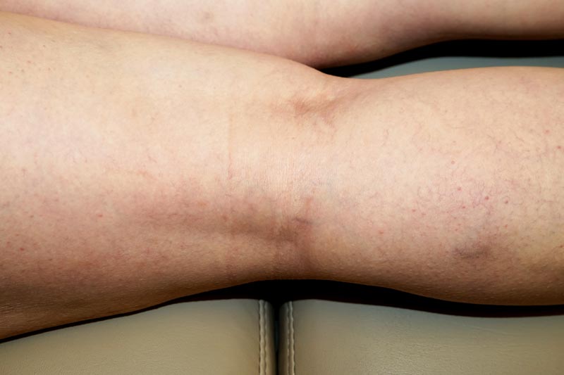 woman's leg after sclero treatment
