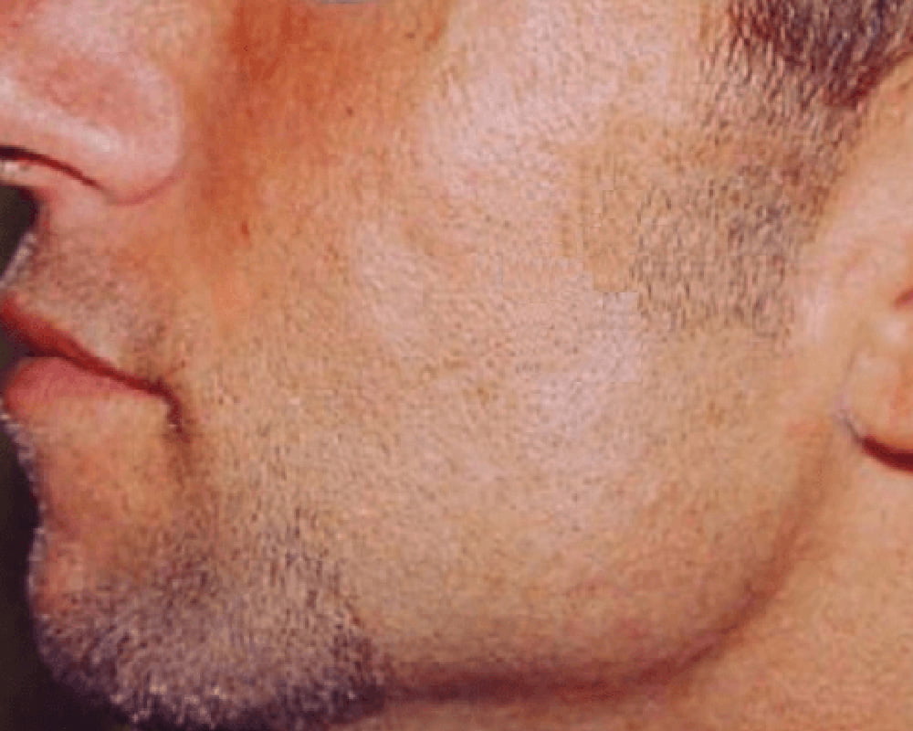 man's jaw after sculptra treatment