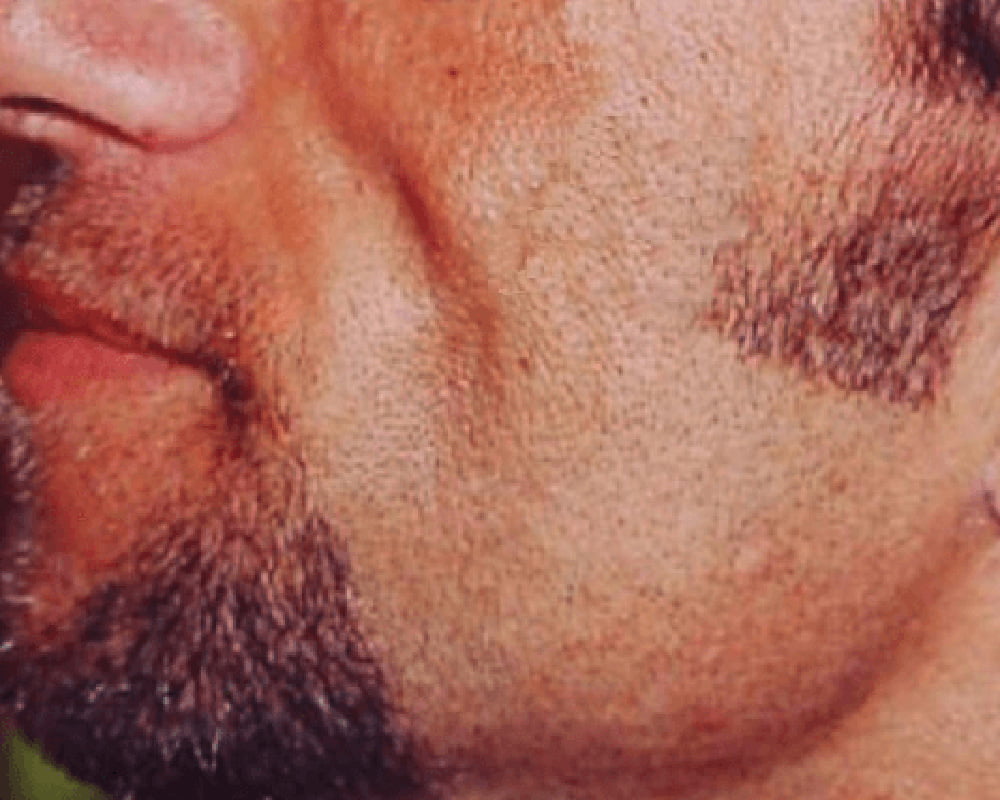man's jaw before treatment