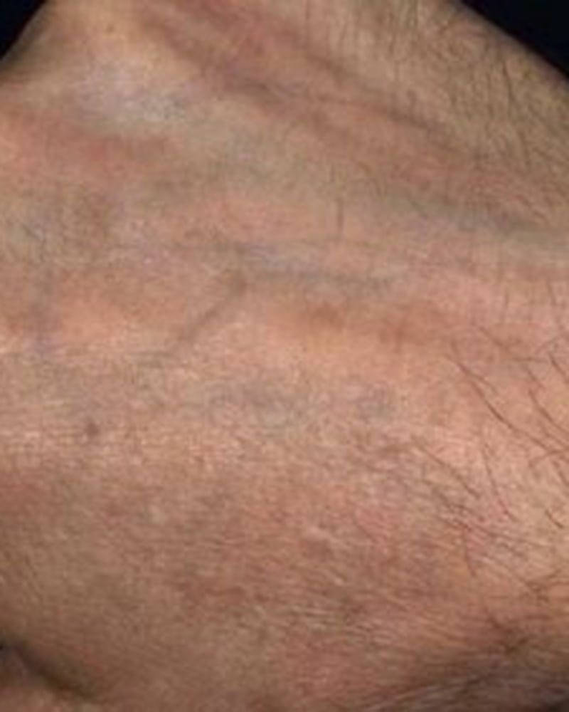 close up of hand after laser treatment