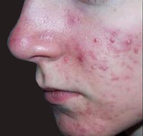close up of acne before treatment