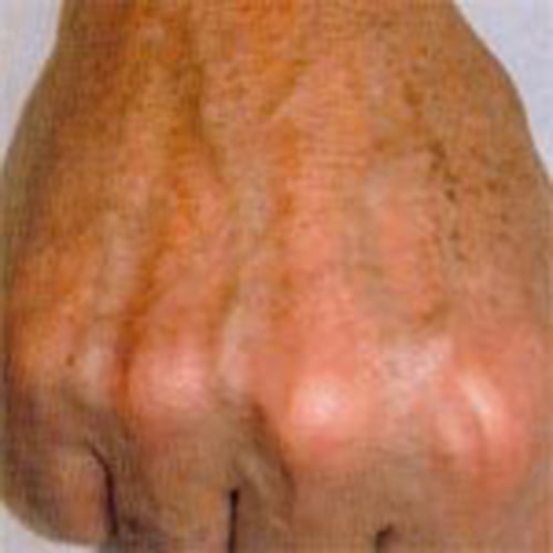 woman's hand after fraxel laser treatment