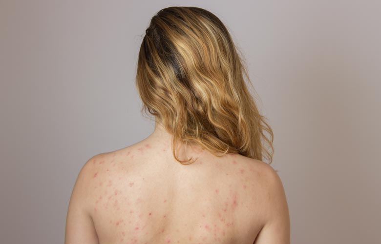 woman with back acne