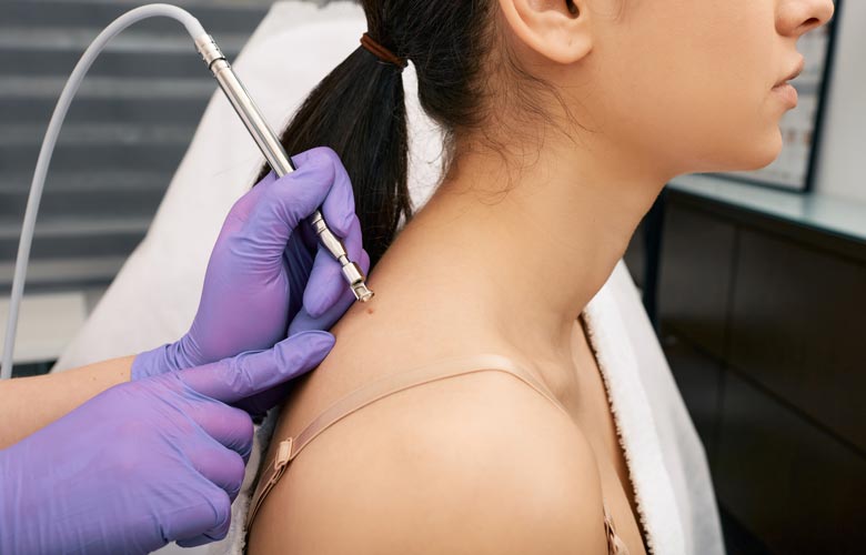 woman getting mole removed