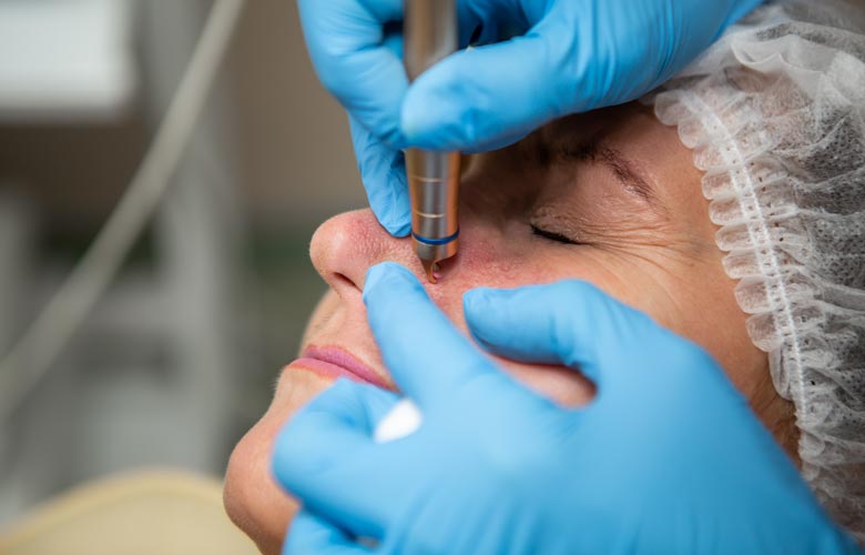 woman receiving rosacea treatment