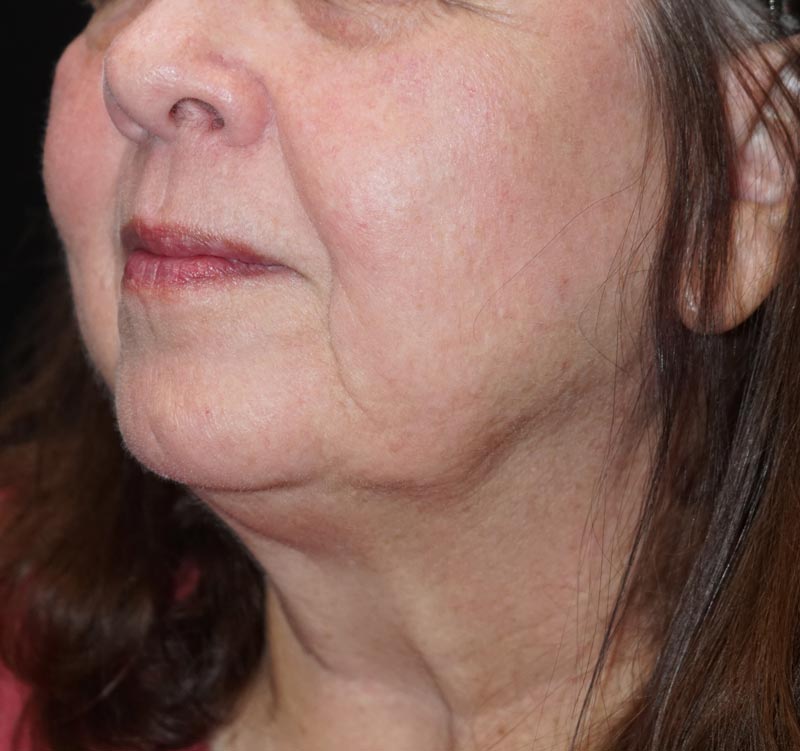 side view of woman's face after diode treatment