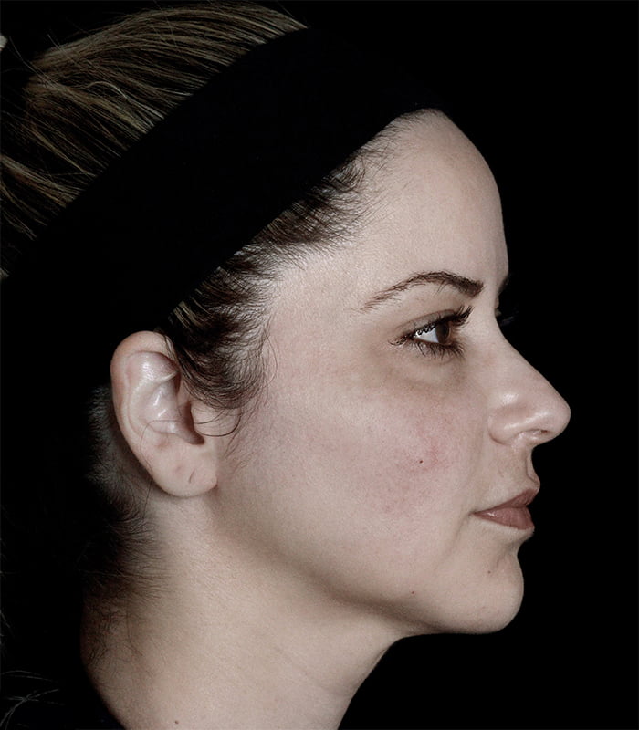woman side view close up of jawline after treatment