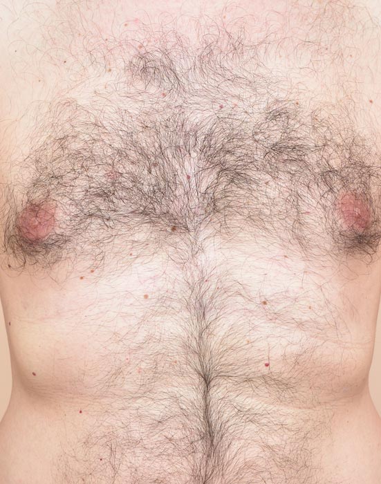 man's chest before laser hair removal