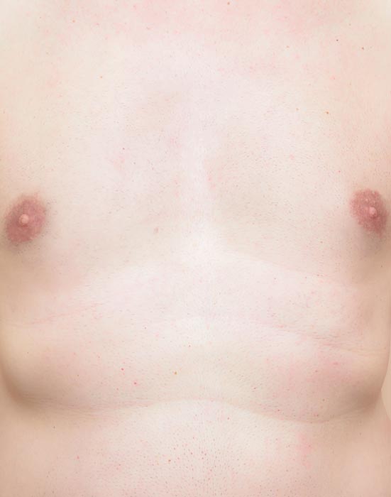 man's chest after laser hair removal
