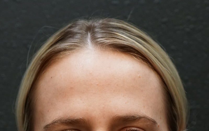 woman's forehead after winkle relaxer