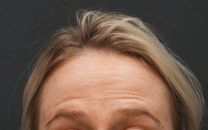 woman's forehead before winkle relaxer