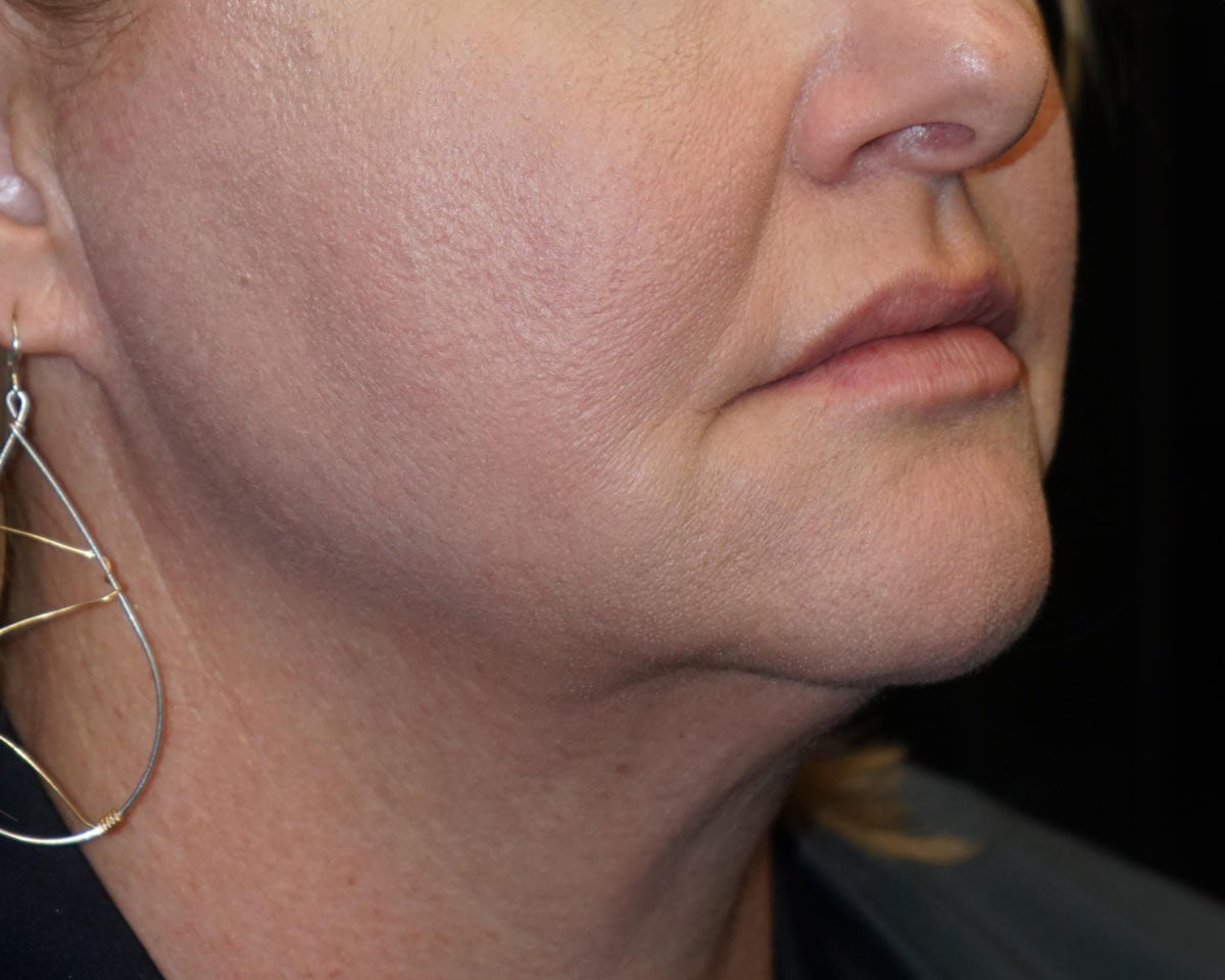 before ulthera upper neck treatment