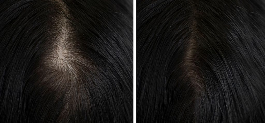 Hair Restoration Before and After