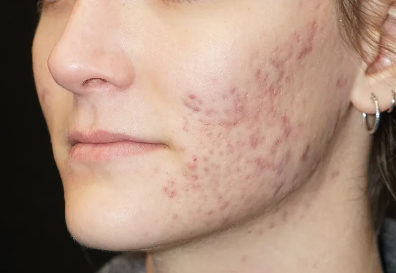 acne-treatment-after-1