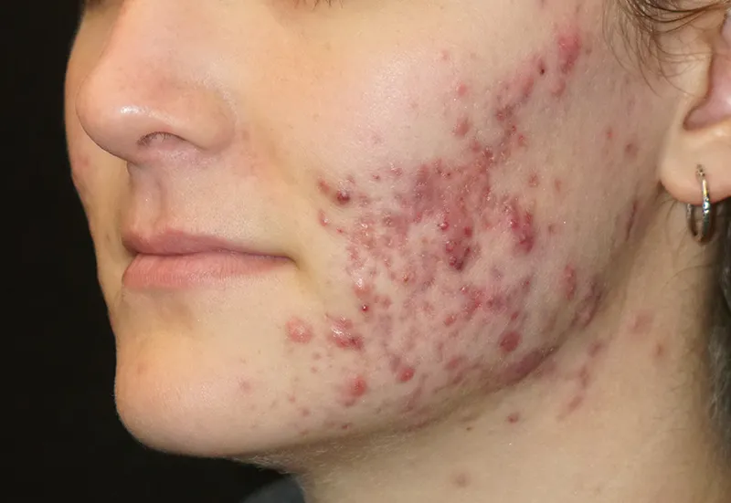 acne-treatment-before-1