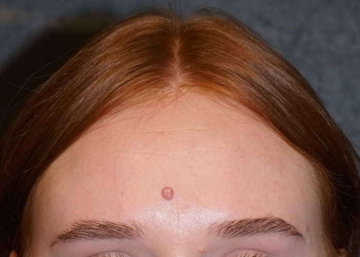 close up of woman's forehead before mole removal