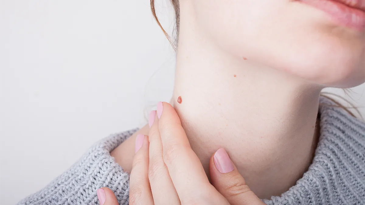 Tracy | Neck Laser Liposuction