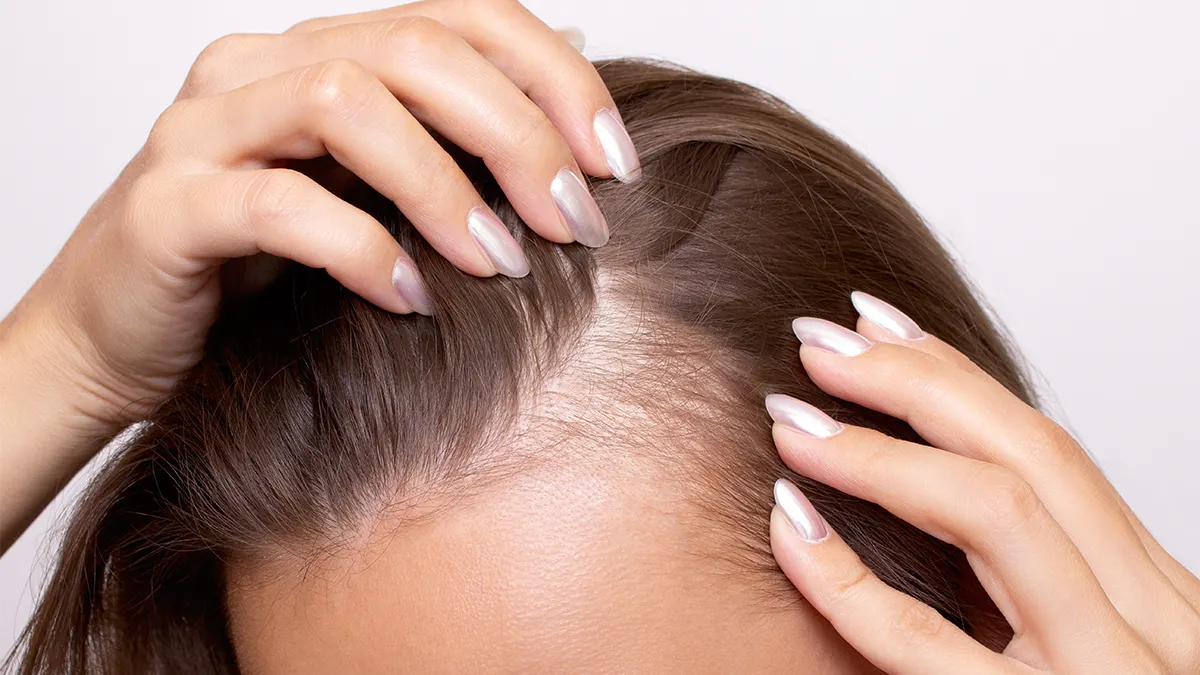Alana | TED Hair Restoration