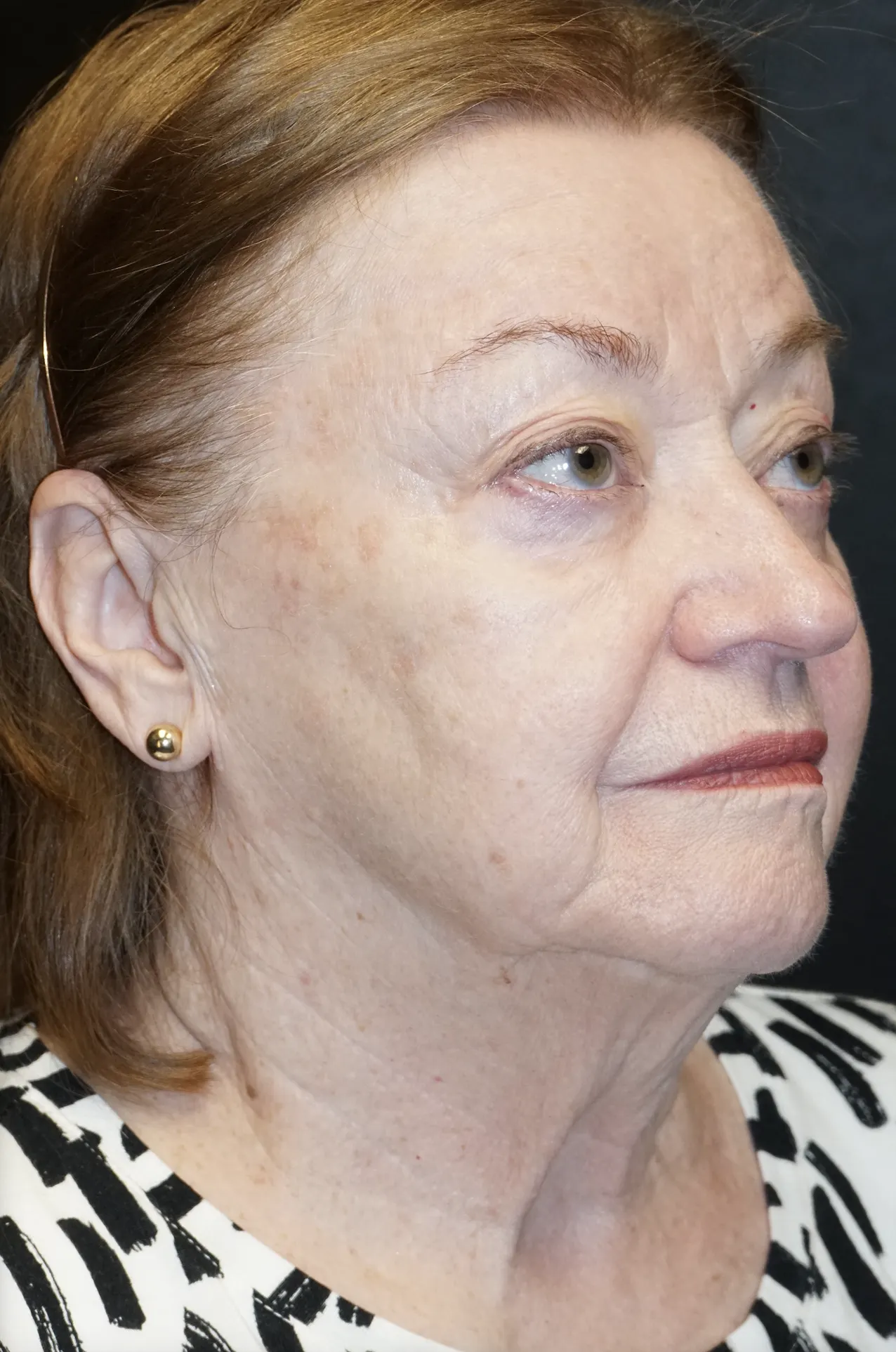 sun damage before treatment