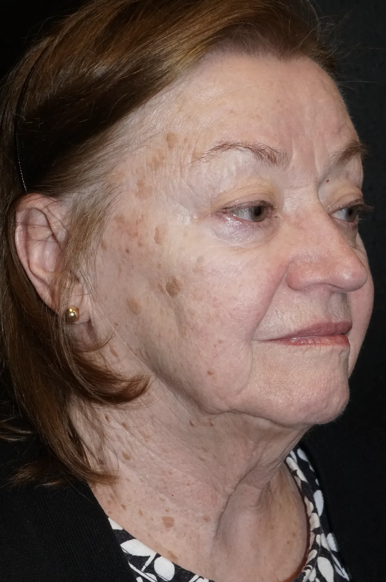 sun damage before treatment