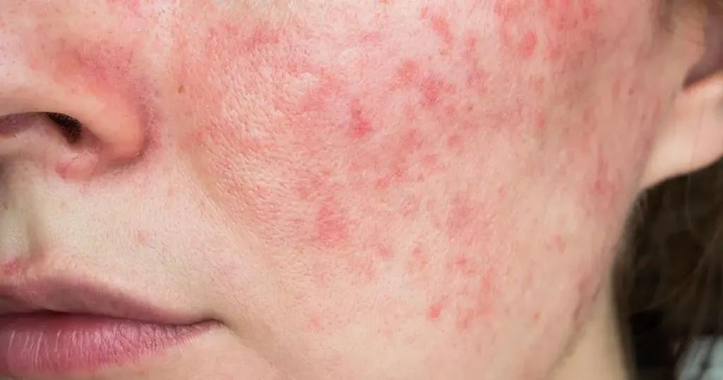 Best Rosacea Treatment Options