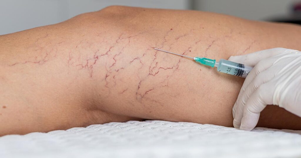 Leg Vein Treatment options in Madison