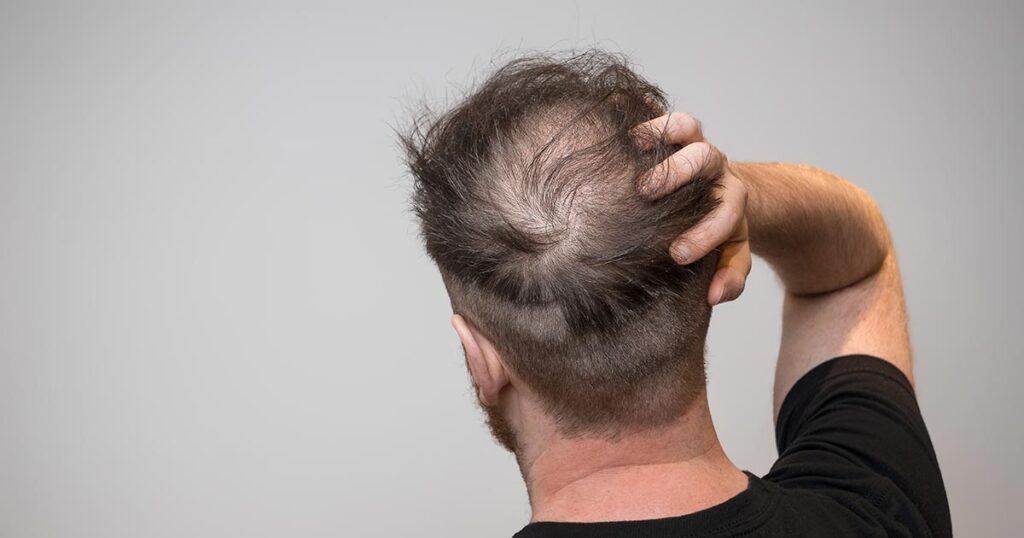 TED Hair Restoration in Madison